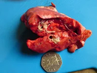 Roe Lungworm 011.webp